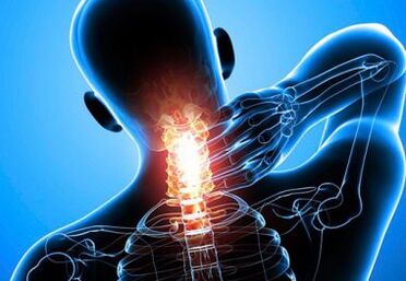 intenzív nyaki fájdalom előrehaladott osteochondrosisban