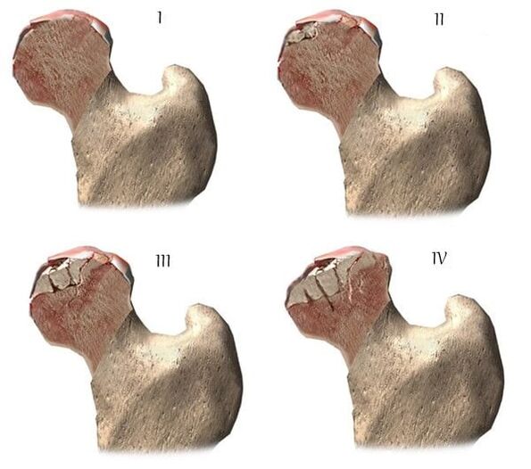 a csípőízület arthrosisának szakaszai