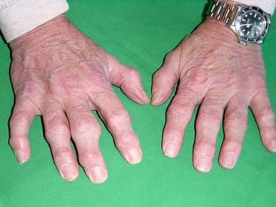 az ujjak arthrosisa