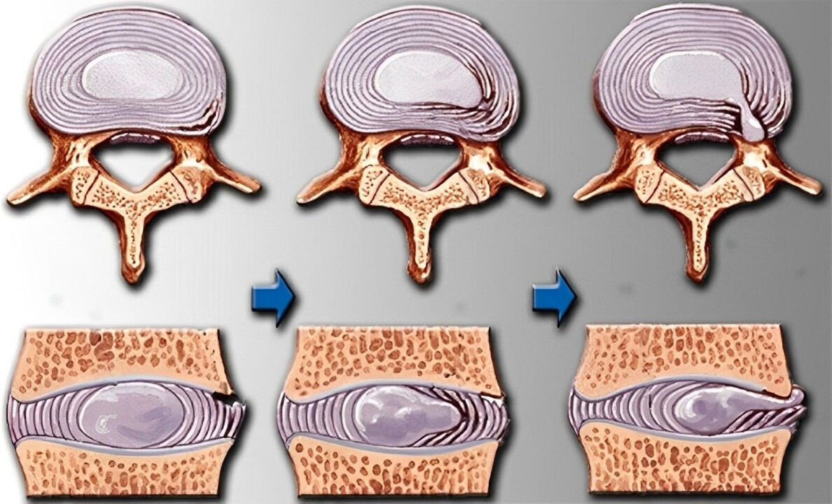 Az osteochondrosis szakaszai