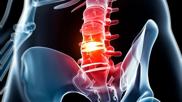az ágyéki gerinc osteochondrosis