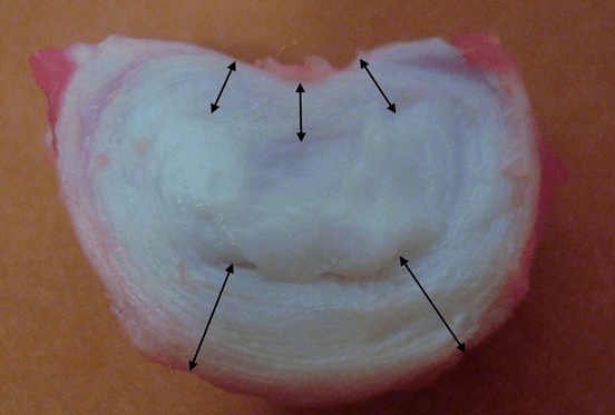 hogy néz ki a csigolyaközi porckorong